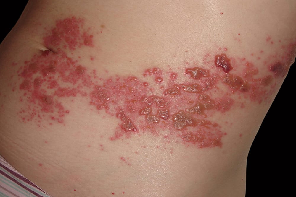 what are shingles a complete guide