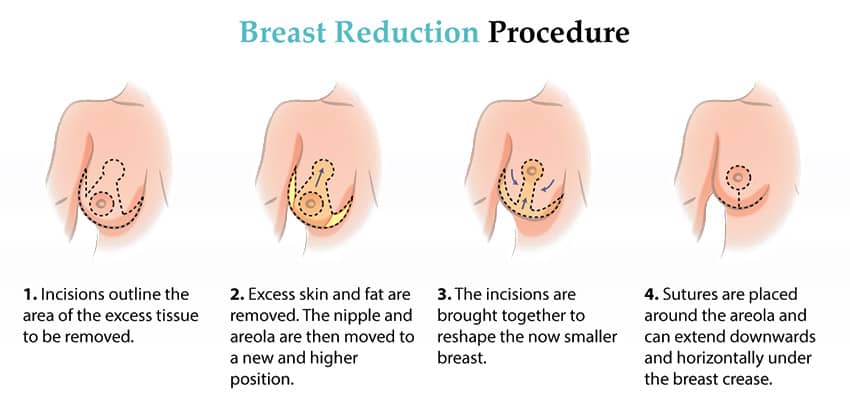 breast reduction surgery