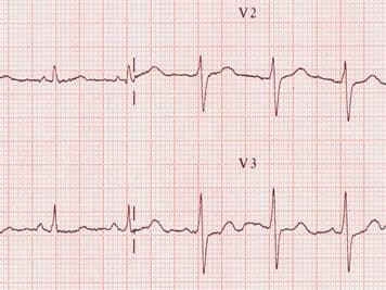 what is a ekg test