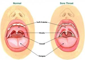 gargling with salt water for a sore throat